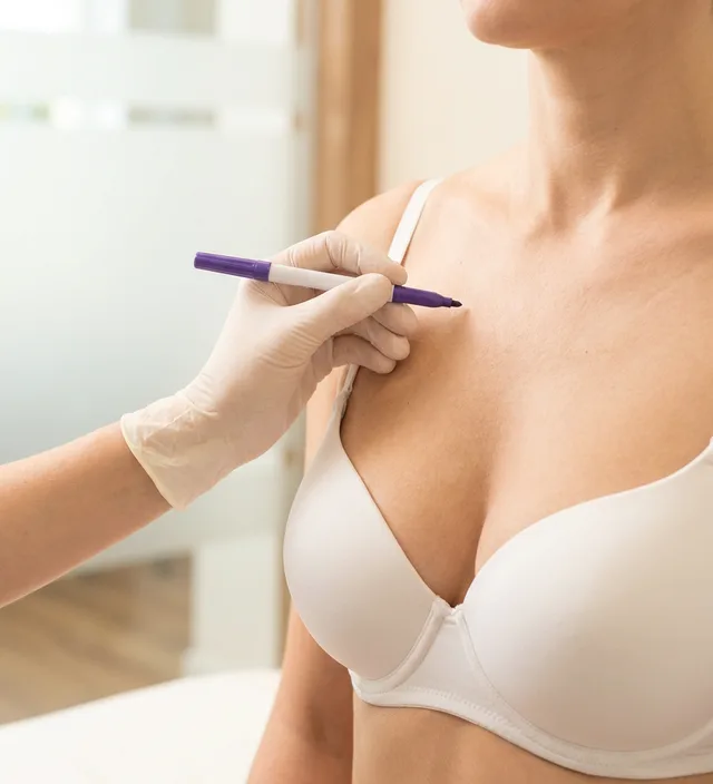 Frau in hellem BH, eine behandschuhte Hand zeichnet mit einem Stift oberhalb der Brust an, zur Hybrid-Brustvergrößerung